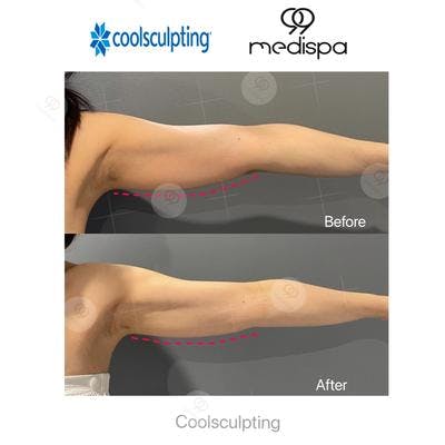 Coolsculpting before and after arms