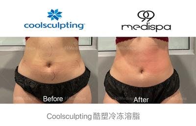 Coolsculpting before and after abdomen
