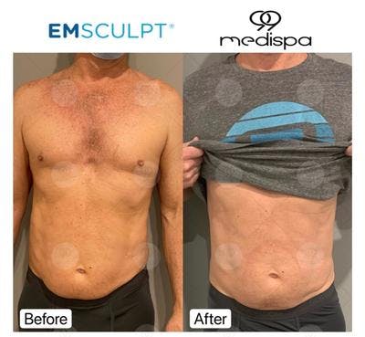 Emsculpt abs before and after male
