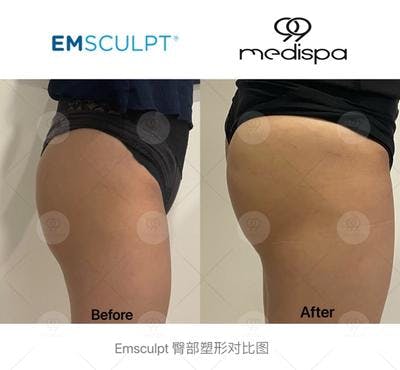 Emsculpt legs buttocks before and after