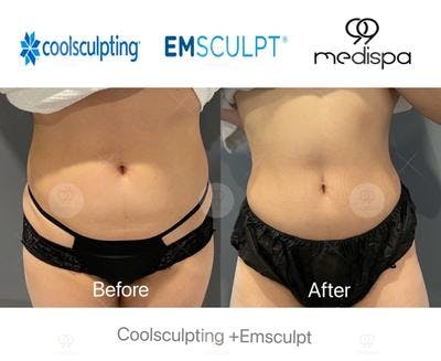 Coolsculpting before and after abdomen