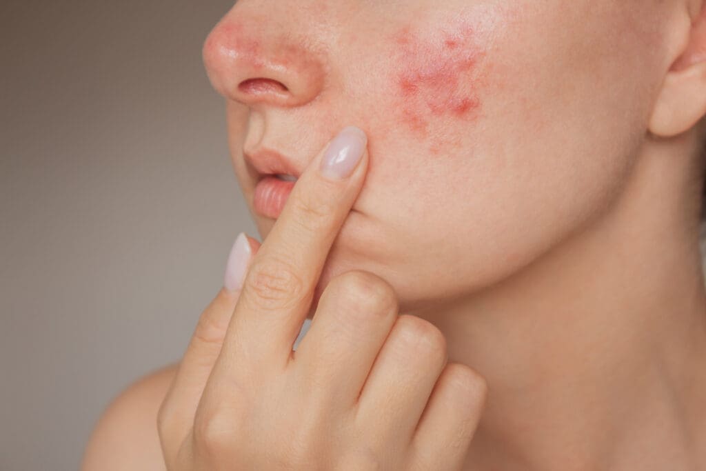 Twinlight Acne Treatment Sydney | Nd:YAG Laser for Acne | 99 Medispa